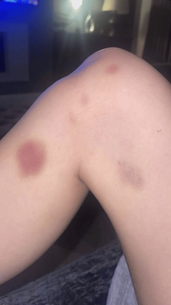 Blue and purple bruises on Harriet’s Robson thighs