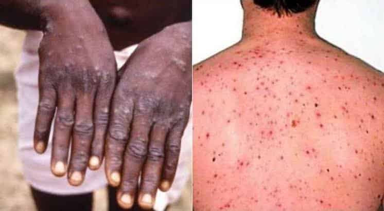 Monkeypox virus seen in a person